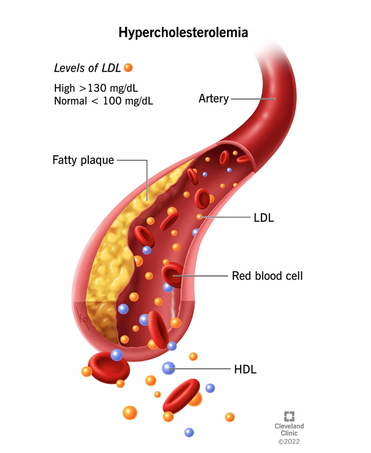 Plaque accumulating and sticking to an artery wall, Cleveland Clinic.